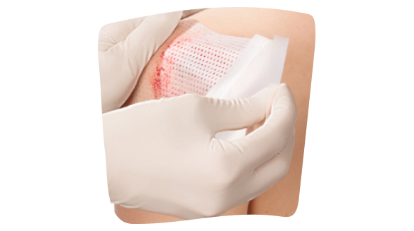 Imagen de una gasa para quemaduras Imagen de una gasa para quemaduras